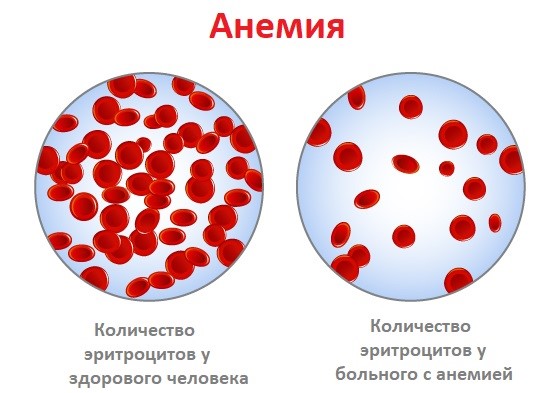 anemia2